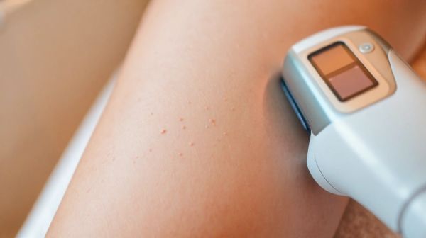 Astuces indispensables pour un épilation laser efficace et durable